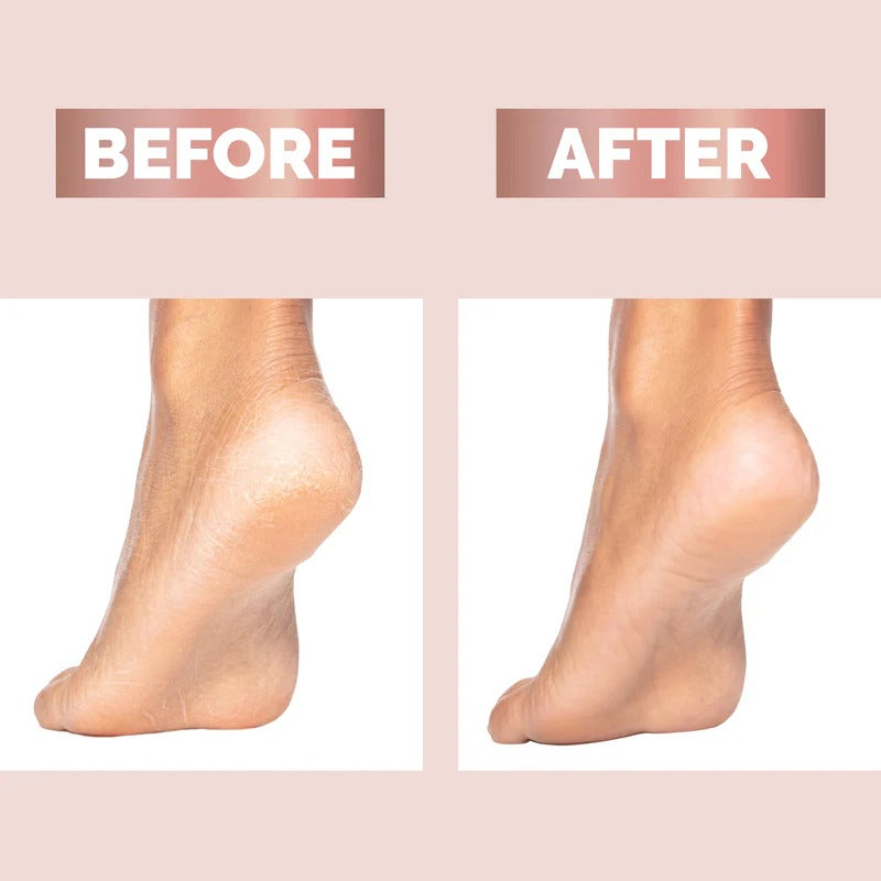 Weimei Electronic Pedicure Tool – Electric Callus Remover