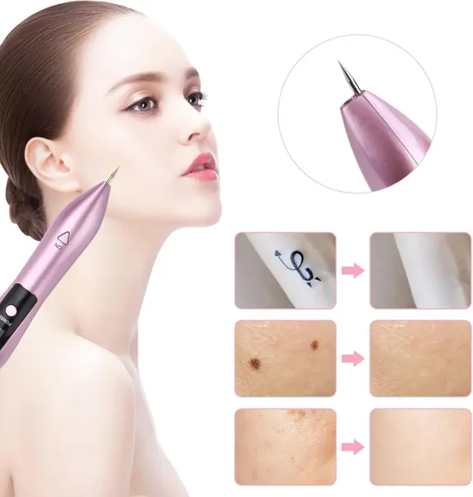 Professional Mole Removal Pen – Dark Spot, Warts & Skin Tag Remover Device – Painless & Portable